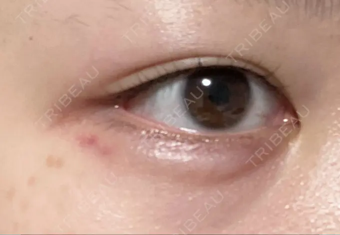 ヒアルロン酸注入（涙袋） / ボトックス（眉間） / ボトックス（ガミースマイル） / ヒアルロン酸注入（鼻翼基部） フィラークリニック 渋谷院 DAY 2 メイン用