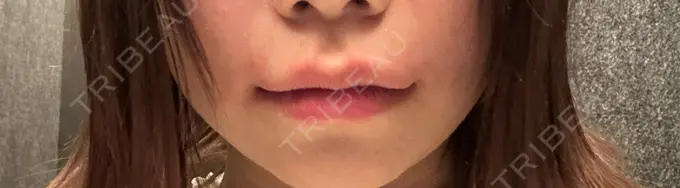 ヒアルロン酸注入（唇） ネビュラクリニック 東京錦糸町院 AFTER メイン用