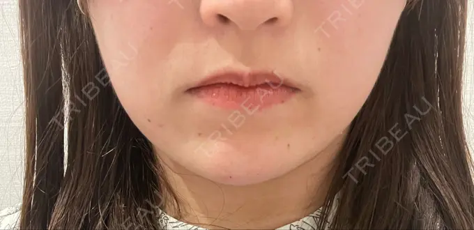 ボトックス（あご） / ヒアルロン酸注入（あご） R Beauty CLINIC 名古屋院 AFTER メイン用
