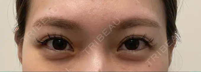 二重埋没 / クマ治療 / その他（目元） R Beauty CLINIC 大阪院 AFTER メイン用