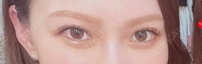 二重埋没 / クマ治療 / その他（目元） R Beauty CLINIC 大阪院 DAY 92 メイン用