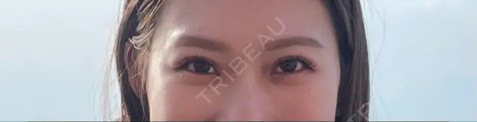 二重埋没 / クマ治療 / その他（目元） R Beauty CLINIC 大阪院 DAY 92 メイン用