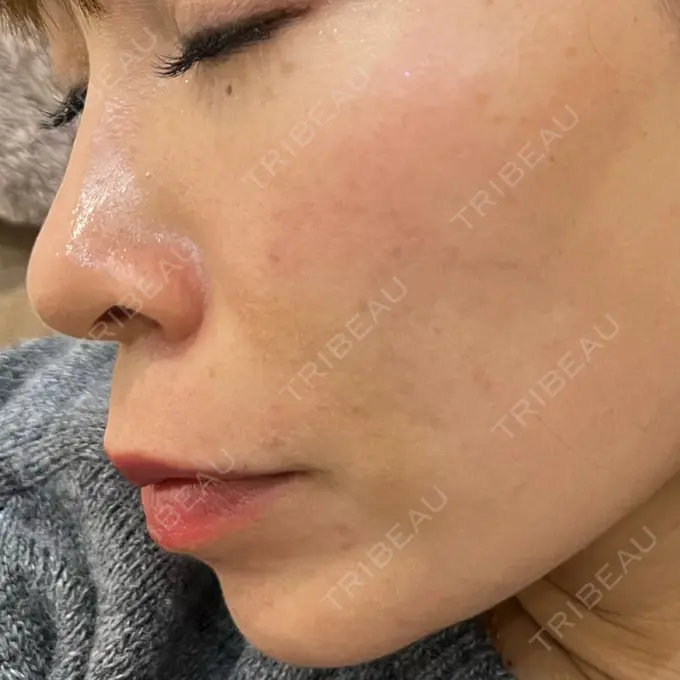 レーザートーニング（美白・肝斑） 椿クリニック 心斎橋院 AFTER メイン用