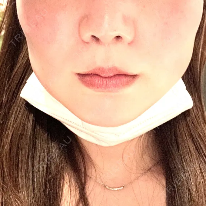 脂肪溶解注射（顔） 表参道ウィズ・クリニック DAY 0 メイン用