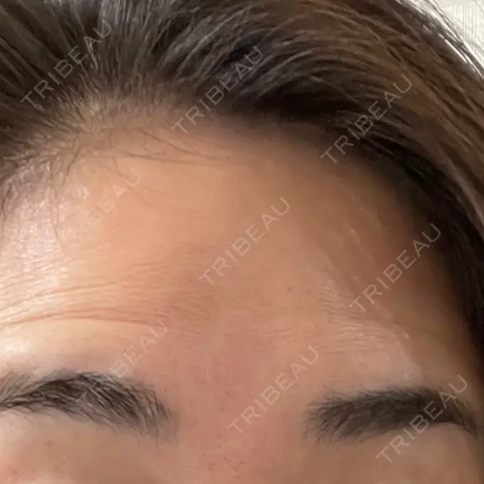 ボトックス（眉間） / ボトックス（額） 湘南美容クリニック 金山院 DAY 3 メイン用