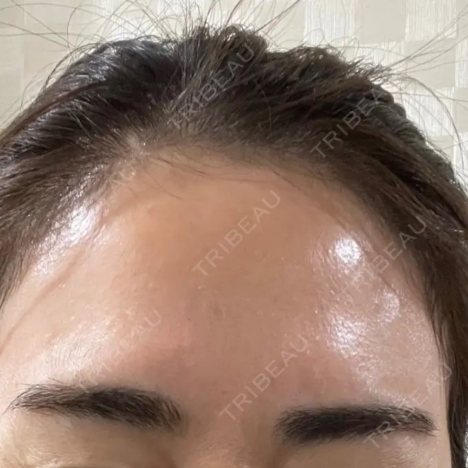 ボトックス（眉間） / ボトックス（額） 湘南美容クリニック 金山院 DAY 4 メイン用