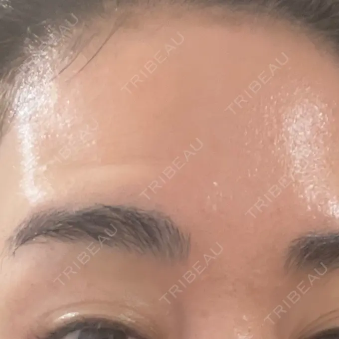 ボトックス（眉間） / ボトックス（額） 湘南美容クリニック 金山院 DAY 5 メイン用