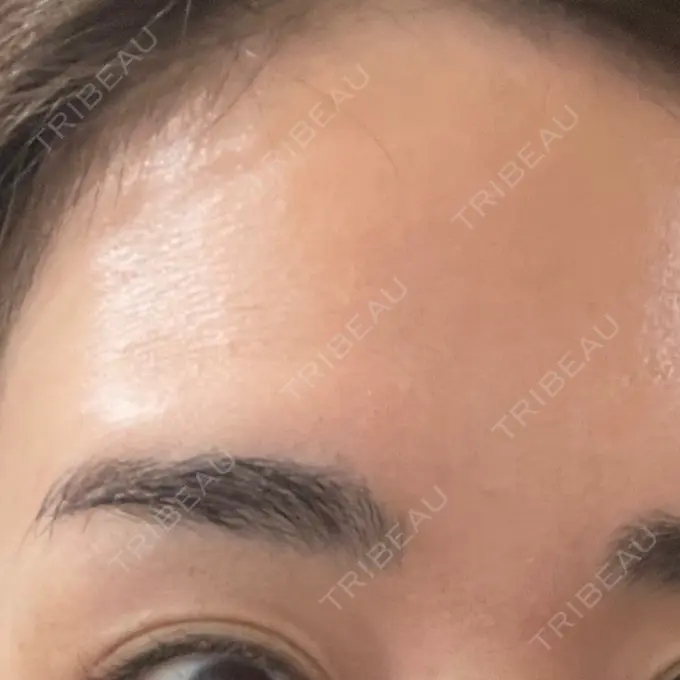 ボトックス（眉間） / ボトックス（額） 湘南美容クリニック 金山院 DAY 7 メイン用