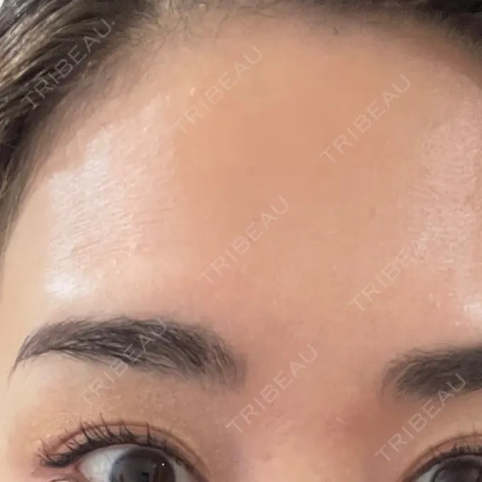 ボトックス（眉間） / ボトックス（額） 湘南美容クリニック 金山院 DAY 8 メイン用