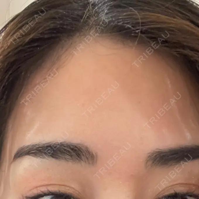 ボトックス（眉間） / ボトックス（額） 湘南美容クリニック 金山院 AFTER メイン用