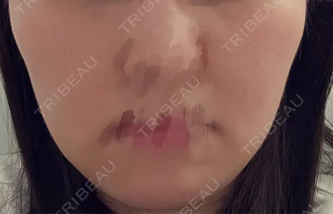 脂肪溶解注射（顔） 吉祥寺アイビークリニック AFTER メイン用