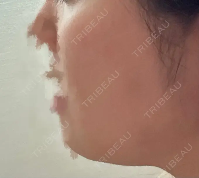 脂肪溶解注射（顔） 吉祥寺アイビークリニック DAY 7 メイン用