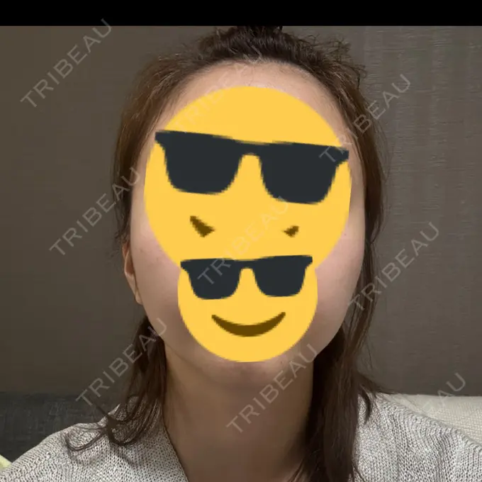 ボトックス（エラ・小顔） TCB東京中央美容外科 自由が丘院 DAY 0 メイン用