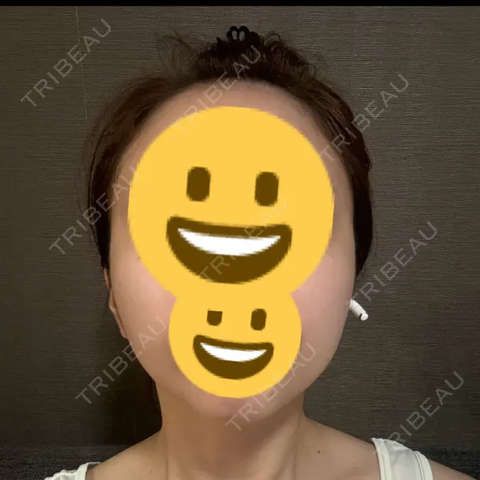 ボトックス（エラ・小顔） TCB東京中央美容外科 自由が丘院 AFTER メイン用