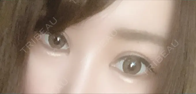 二重切開 / 眼瞼下垂（切開） / 目尻切開 / タレ目形成・グラマラスライン（切開） / 前額リフト レアート整形外科 AFTER メイン用