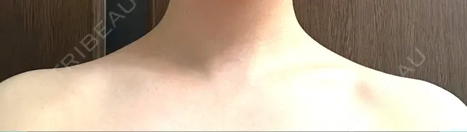 ボトックス（肩） 共立美容外科 名古屋院 DAY 7 メイン用