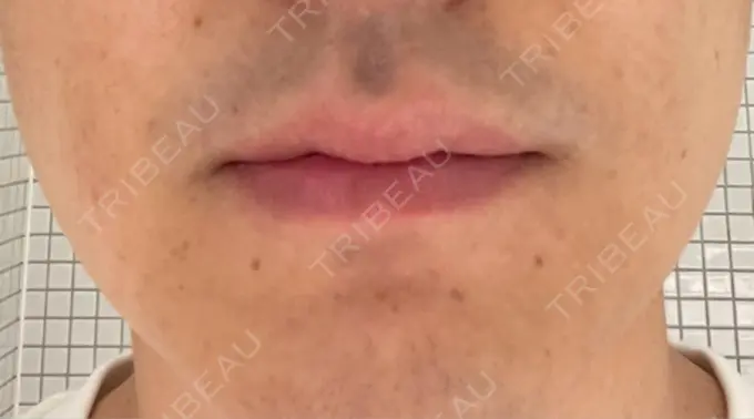 ボトックス（エラ・小顔） TCB東京中央美容外科 新宿三丁目院 DAY 0 メイン用