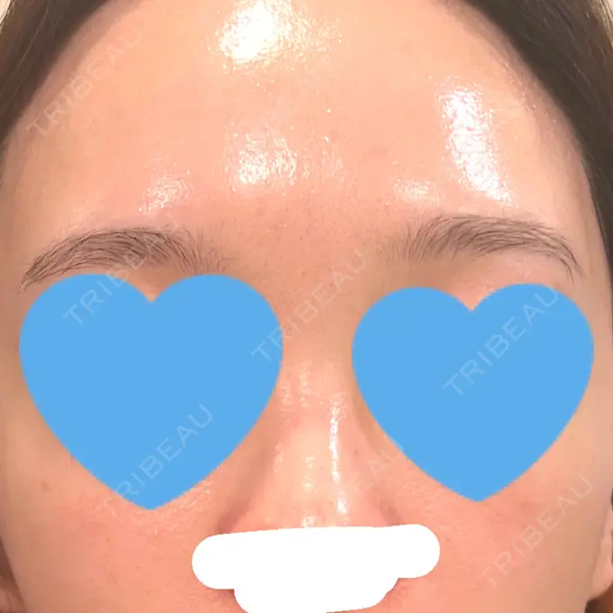 エレクトロポレーション / ルメッカ ゆきスキンクリニック 東池袋 AFTER メイン用