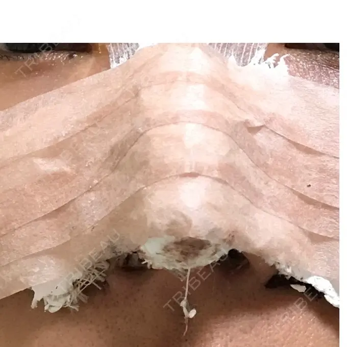 鼻尖形成（切開） 水の森美容クリニック 名古屋院 DAY 1 メイン用