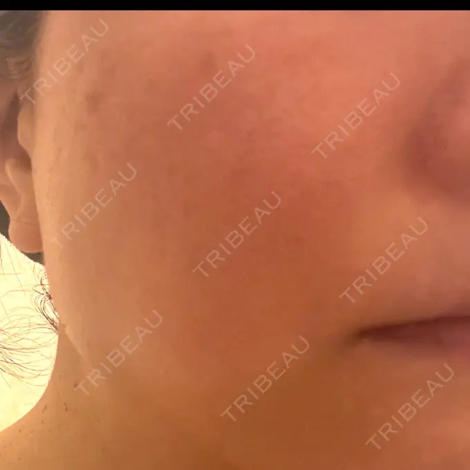 イオン導入 / レーザートーニング（美白・肝斑） / ピーリング（ハリ・ツヤ） 新宿美容外科クリニック 立川院 DAY 0 メイン用