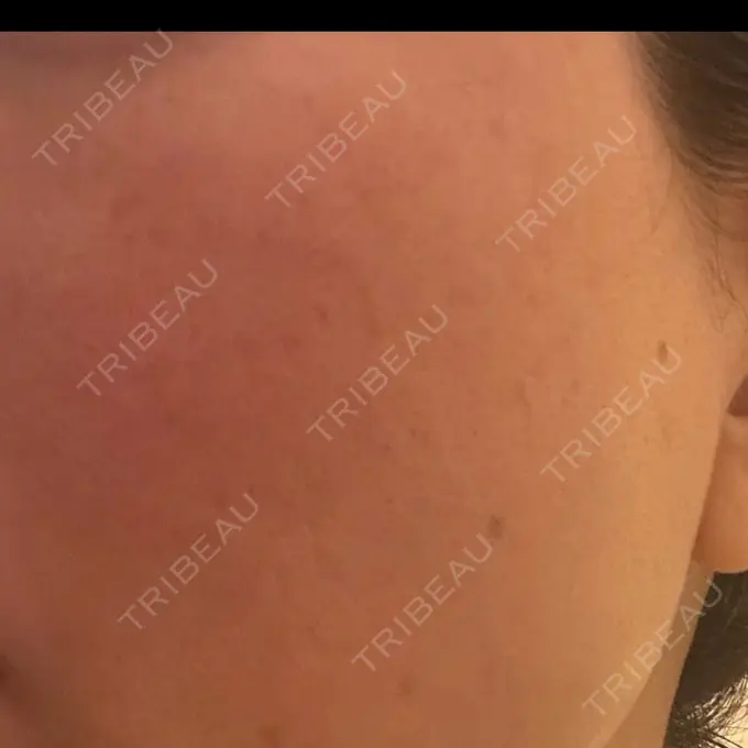 イオン導入 / レーザートーニング（美白・肝斑） / ピーリング（ハリ・ツヤ） 新宿美容外科クリニック 立川院 DAY 0 メイン用