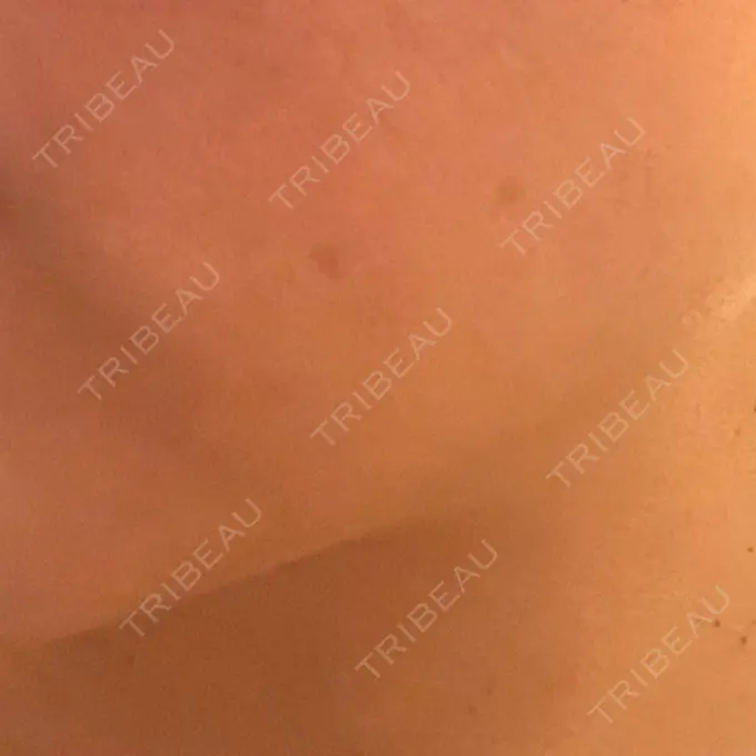 イオン導入 / レーザートーニング（美白・肝斑） / ピーリング（ハリ・ツヤ） 新宿美容外科クリニック 立川院 DAY 0 メイン用