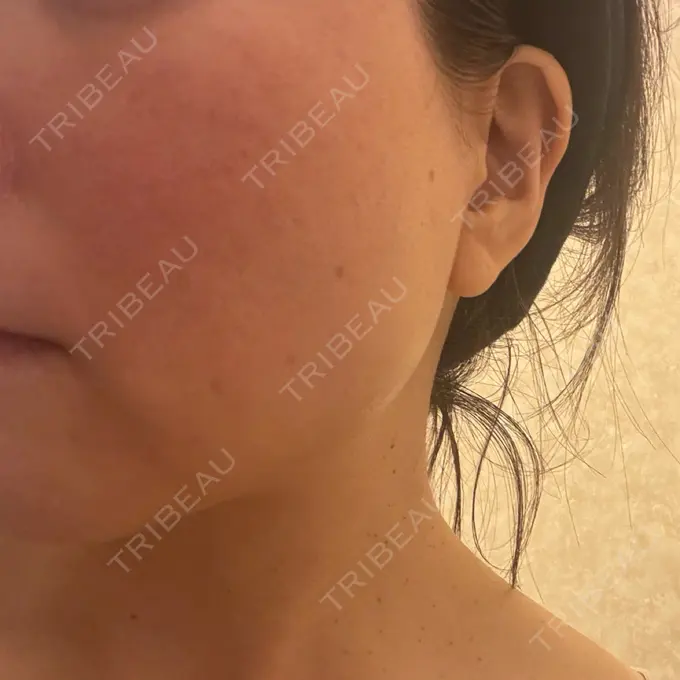 イオン導入 / レーザートーニング（美白・肝斑） / ピーリング（ハリ・ツヤ） 新宿美容外科クリニック 立川院 DAY 1 メイン用