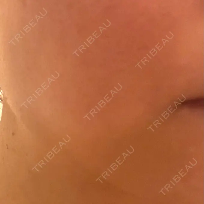 イオン導入 / レーザートーニング（美白・肝斑） / ピーリング（ハリ・ツヤ） 新宿美容外科クリニック 立川院 DAY 1 メイン用