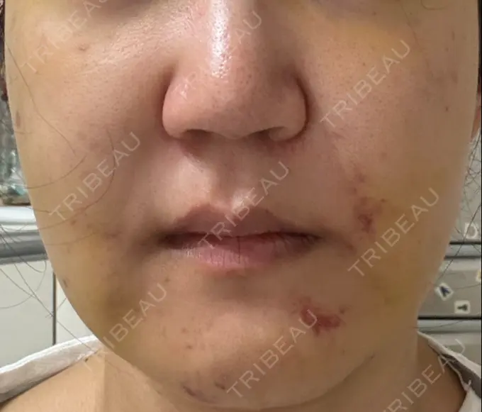 脂肪吸引（顔） スノウ（Snow）整形外科 DAY 7 メイン用