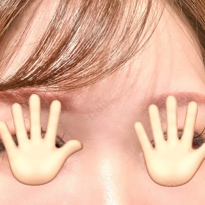 小鼻縮小（非切開） / シワ取りボトックス / ボトックス（眉間） / その他（鼻） TCB東京中央美容外科 横浜駅前院 AFTER メイン用