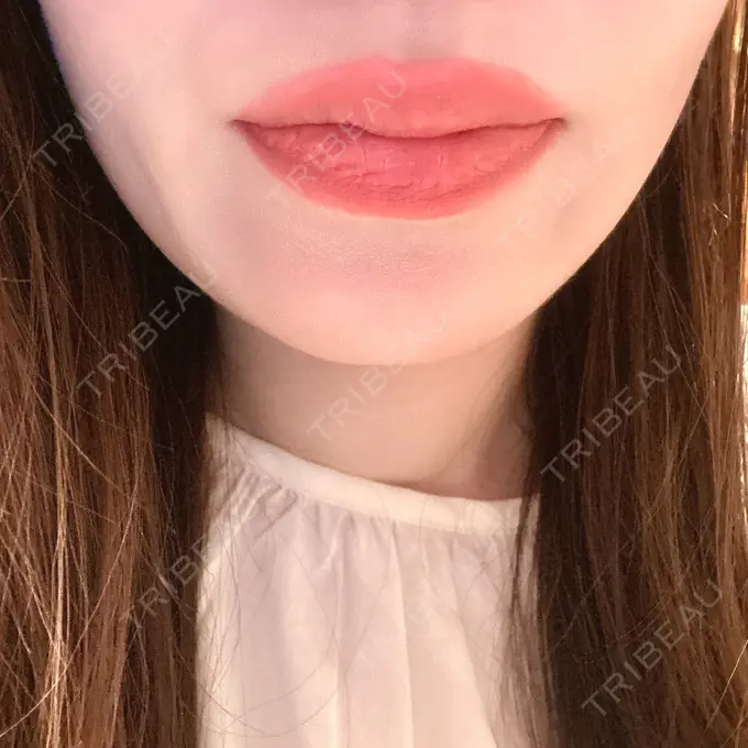 小鼻縮小（非切開） / シワ取りボトックス / ボトックス（眉間） / その他（鼻） TCB東京中央美容外科 横浜駅前院 DAY 7 メイン用