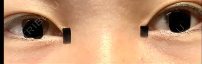 アートメイク（アイライン） 筋肉・美容クリニック AFTER メイン用