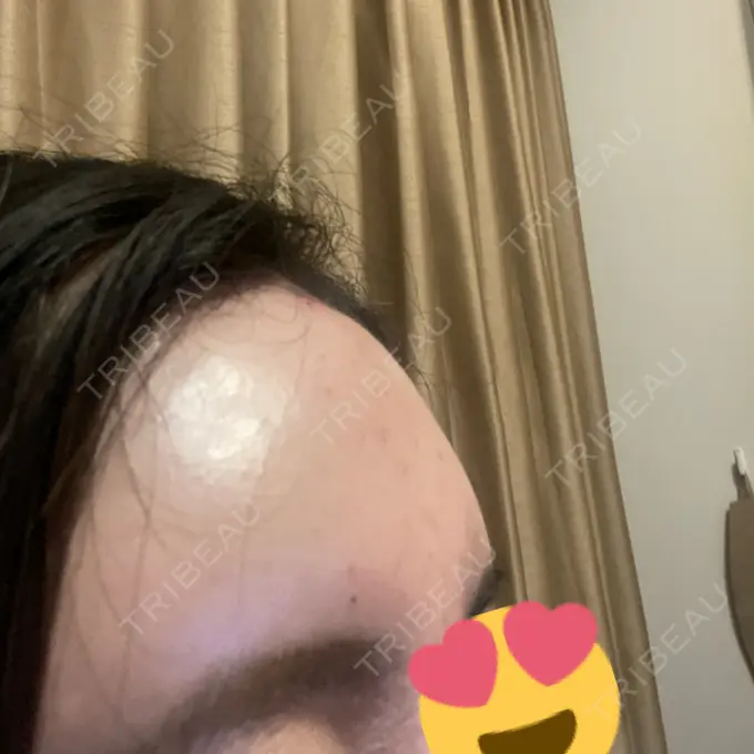 ヒアルロン酸注入（額） / ヒアルロン酸注入（頬） / ヒアルロン酸注入（こめかみ） / ボトックス（眉間） LA CLEF CLINIC（ラクレクリニック） DAY 0 メイン用