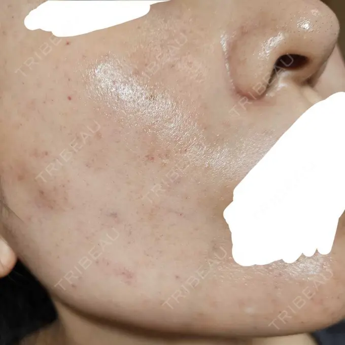 水光注射（ハリ・美肌） オラクル美容皮膚科 名古屋院 DAY 0 メイン用