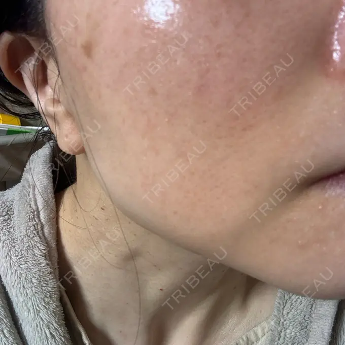 イオン導入 / レーザートーニング（美白・肝斑） / ピーリング（ハリ・ツヤ） 新宿美容外科クリニック 立川院 AFTER メイン用