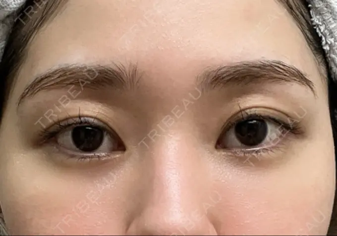 クマ治療 / 脂肪注入（目の下） 吉井クリニック DAY 16 メイン用