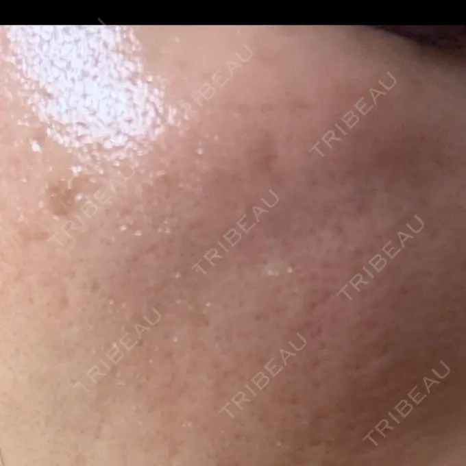 イオン導入 / レーザートーニング（美白・肝斑） / ピーリング（ハリ・ツヤ） 新宿美容外科クリニック 立川院 DAY 2 メイン用