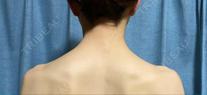 ボトックス（肩） 共立美容外科 名古屋院 AFTER メイン用