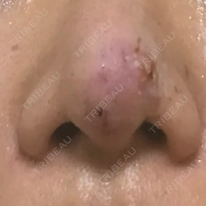 鼻尖形成（切開） 水の森美容クリニック 名古屋院 DAY 5 メイン用