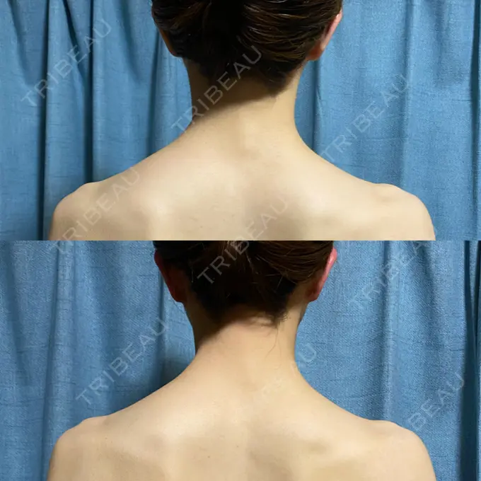 ボトックス（肩） 共立美容外科 名古屋院 DAY 29 メイン用