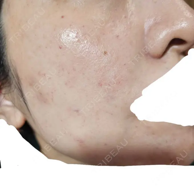 水光注射（ハリ・美肌） オラクル美容皮膚科 名古屋院 DAY 1 メイン用