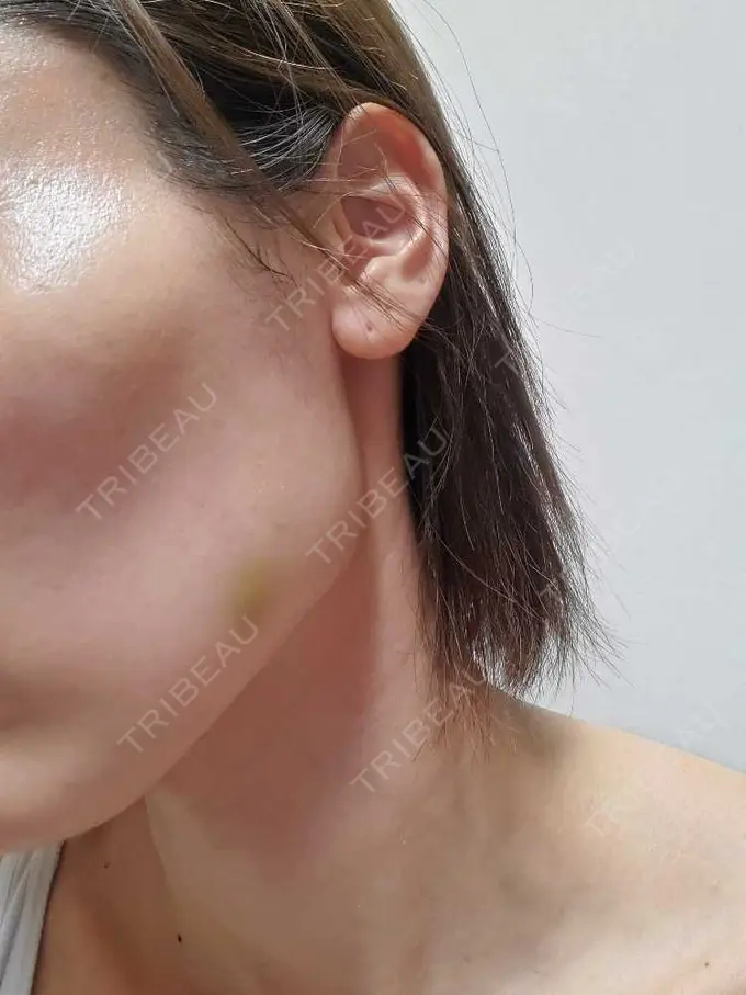 ボトックス（エラ・小顔） / ピーリング（ニキビ・毛穴） / イオン導入 ルラ美容クリニック 上野院 DAY 7 メイン用