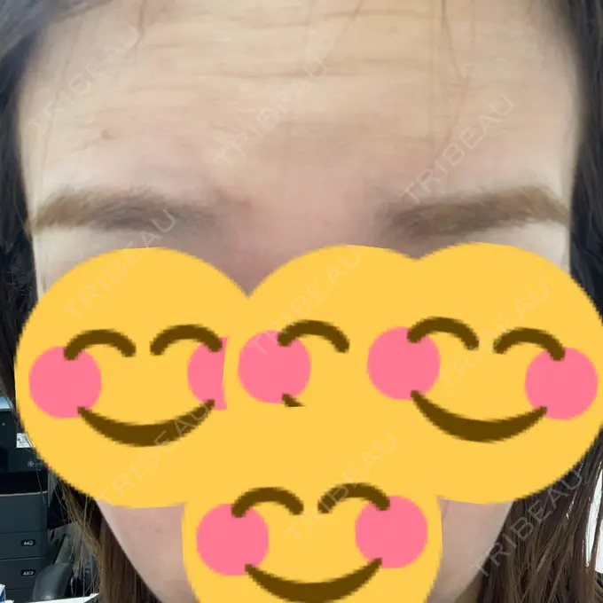 ボトックス（エラ・小顔） / ワキ汗治療（ボトックス） / ボトックス（眉間） / ボトックス（目尻） TCB東京中央美容外科 岐阜院 DAY 0 メイン用