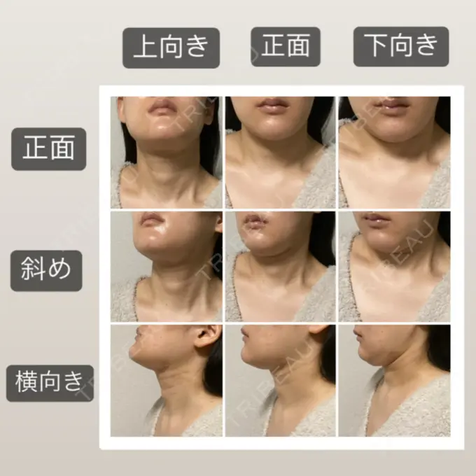 脂肪吸引（顔） 湘南美容クリニック 秋葉原院 DAY 21 メイン用