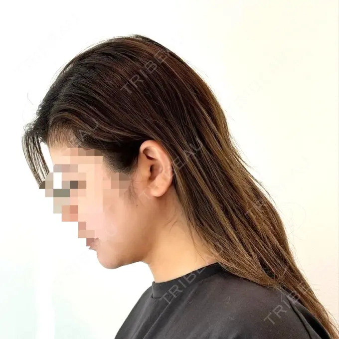 糸リフト / 脂肪吸引（顔） yuzawa clinic AFTER メイン用