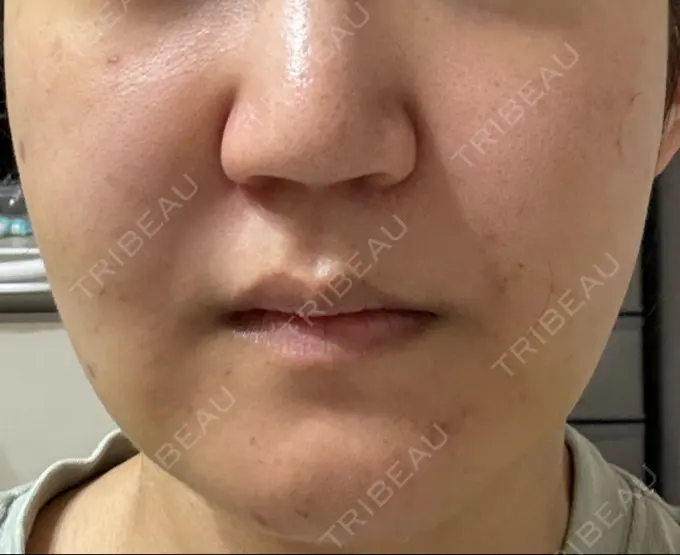 脂肪吸引（顔） スノウ（Snow）整形外科 DAY 9 メイン用