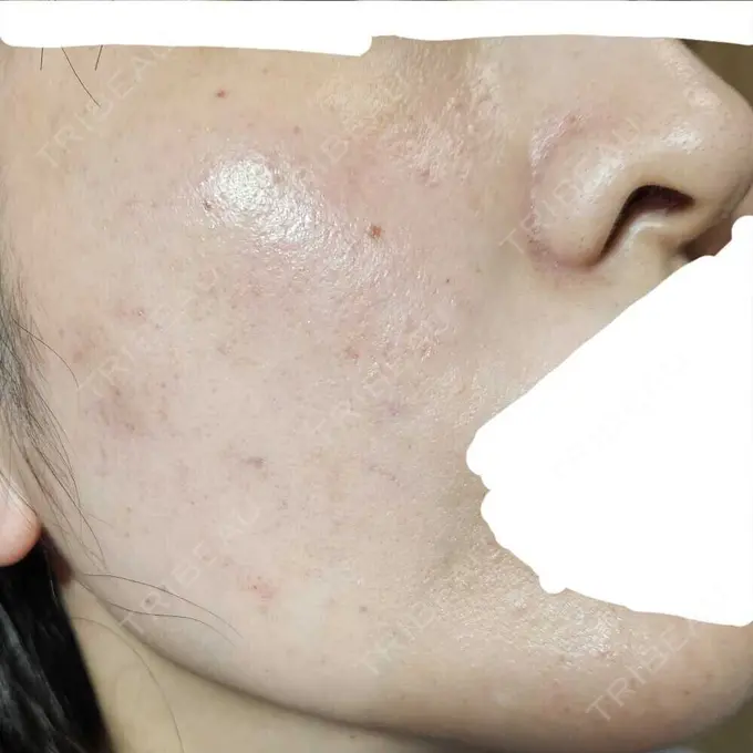 水光注射（ハリ・美肌） オラクル美容皮膚科 名古屋院 DAY 2 メイン用