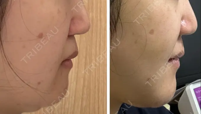 脂肪吸引（顔） スノウ（Snow）整形外科 DAY 11 メイン用