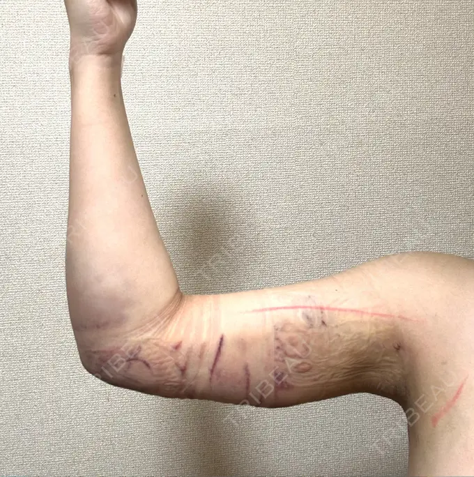 脂肪吸引（二の腕） アムルーズ美容外科クリニック 横浜院 DAY 1 メイン用