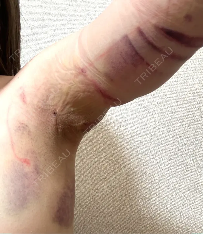 脂肪吸引（二の腕） アムルーズ美容外科クリニック 横浜院 DAY 1 メイン用